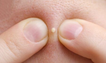 best pimple popping videos
