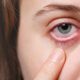 what is commonly misdiagnosed as pink eye