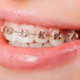 Lincoln Park Invisalign